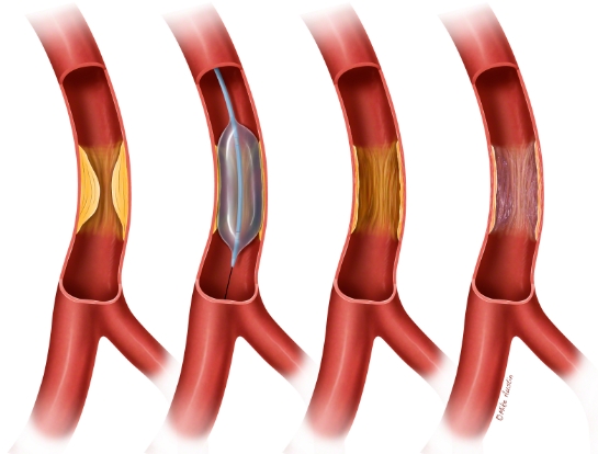 Angioplastia