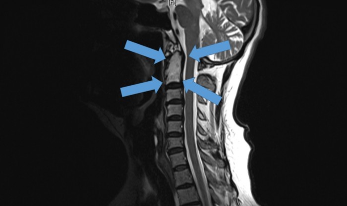 Tumor nas vertebras